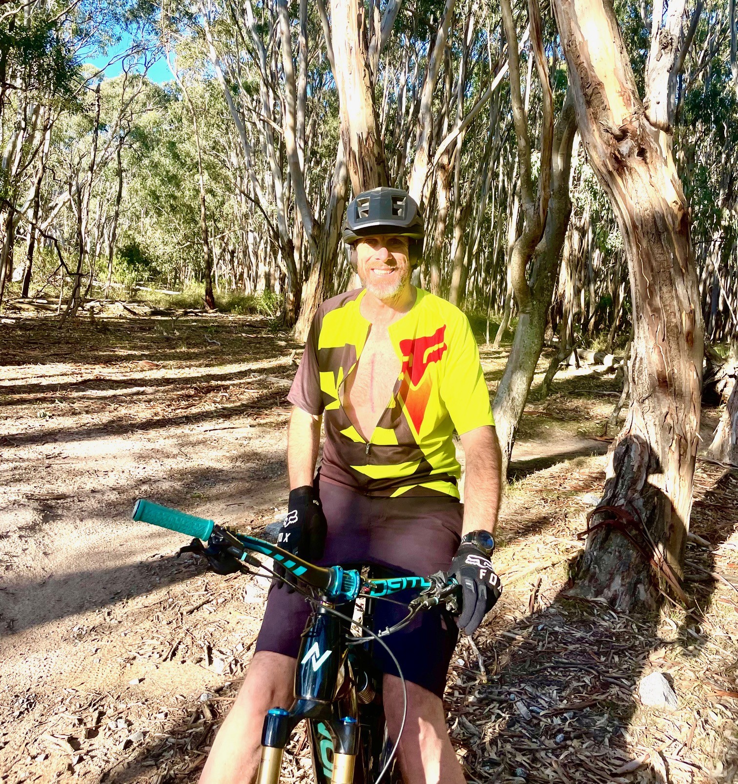Alex sits on a mountain bike with his jersey unzipped to reveal a large scar on his chest.